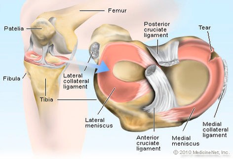 torn meniscus diagram