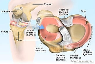 physical therapy meniscus knee pain
