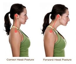 Before & After Head Posture - Physical Therapy