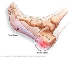 physical therapy plantar