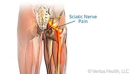 physical therapy sciatica image