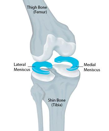 Meniscus Tear | Treating Meniscus Tear With Surgery or Physical Therapy