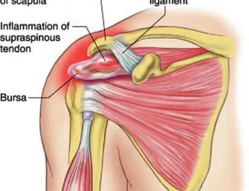 Thoracic Outlet Syndrome: The Basics