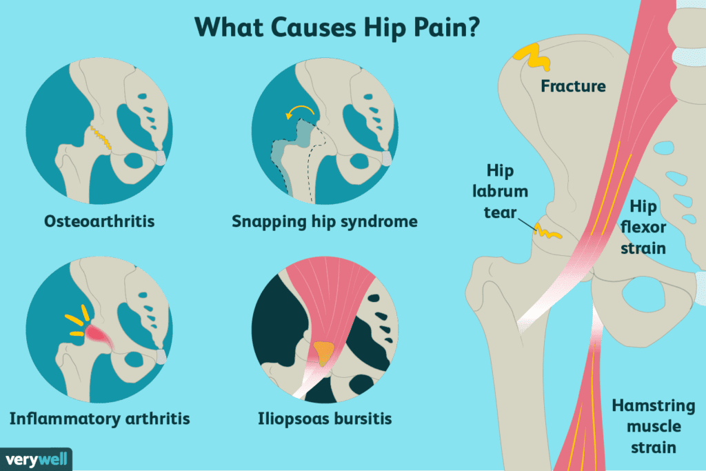 Hip Pain: How To Make It Worse