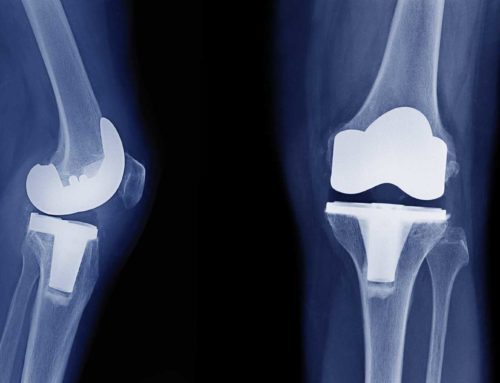 Total Knee Replacements – Procedures and Alternatives