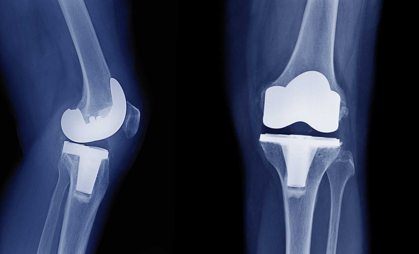Total Knee Replacements - Physical Therapy