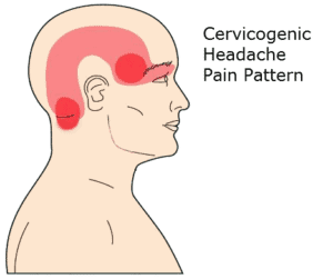 Headache from neck pain illustration
