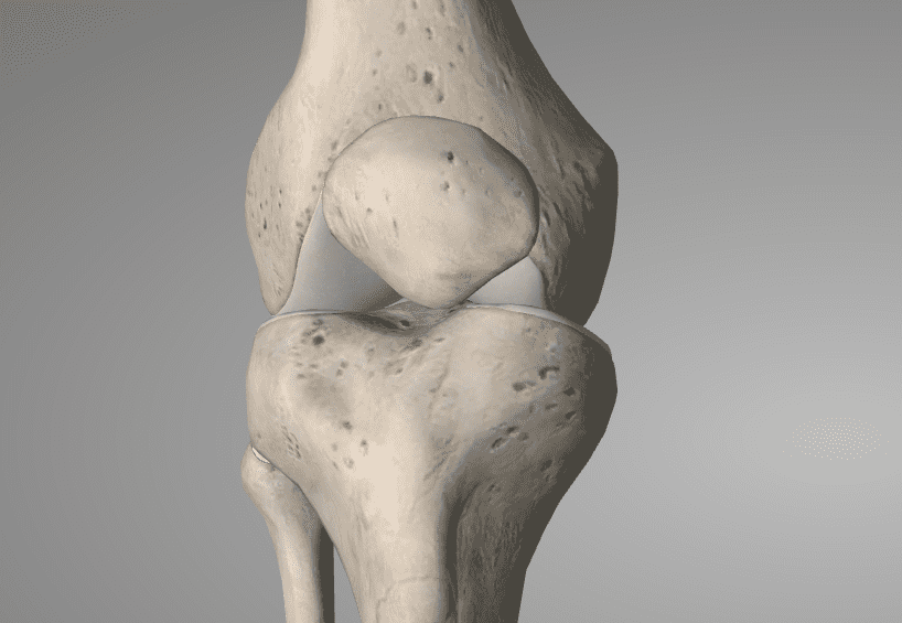 Knee Arthritis - Physical Therapy