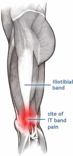 IT Band Pain | Three Myths about IT Band Pain at DPT Scottsdale, AZ