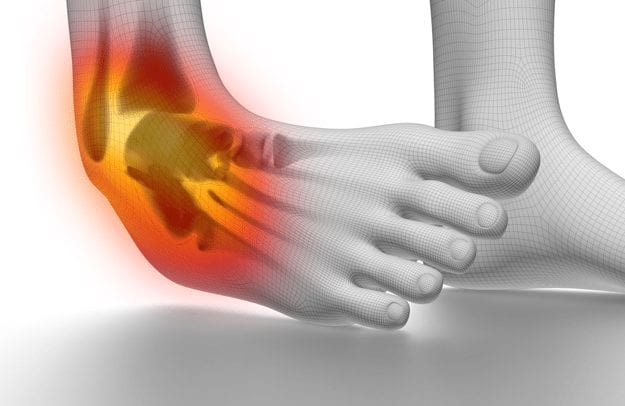 Ankle Sprain - Physical Therapy