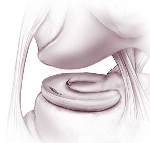 Meniscal Tears - Physical Therapy