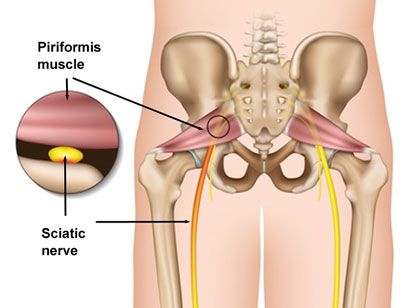 Piriformis Syndrome, The Root Cause And How To Fix It