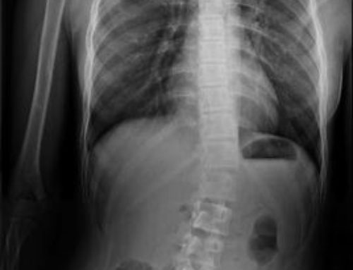 Can Physical Therapy Help With Scoliosis?