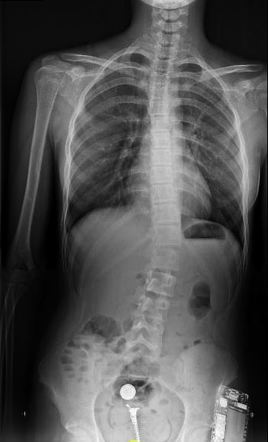 Scoliosis X-ray - Physical Therapy