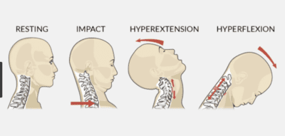 Whiplash And Neck Pain | Symptoms, Causes, and Treatments at DPT